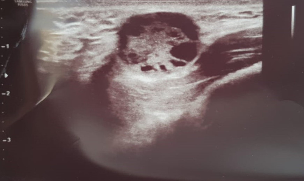 Ultrasonography shows a hyperechoic heterogeneous round mass without any internal flow.