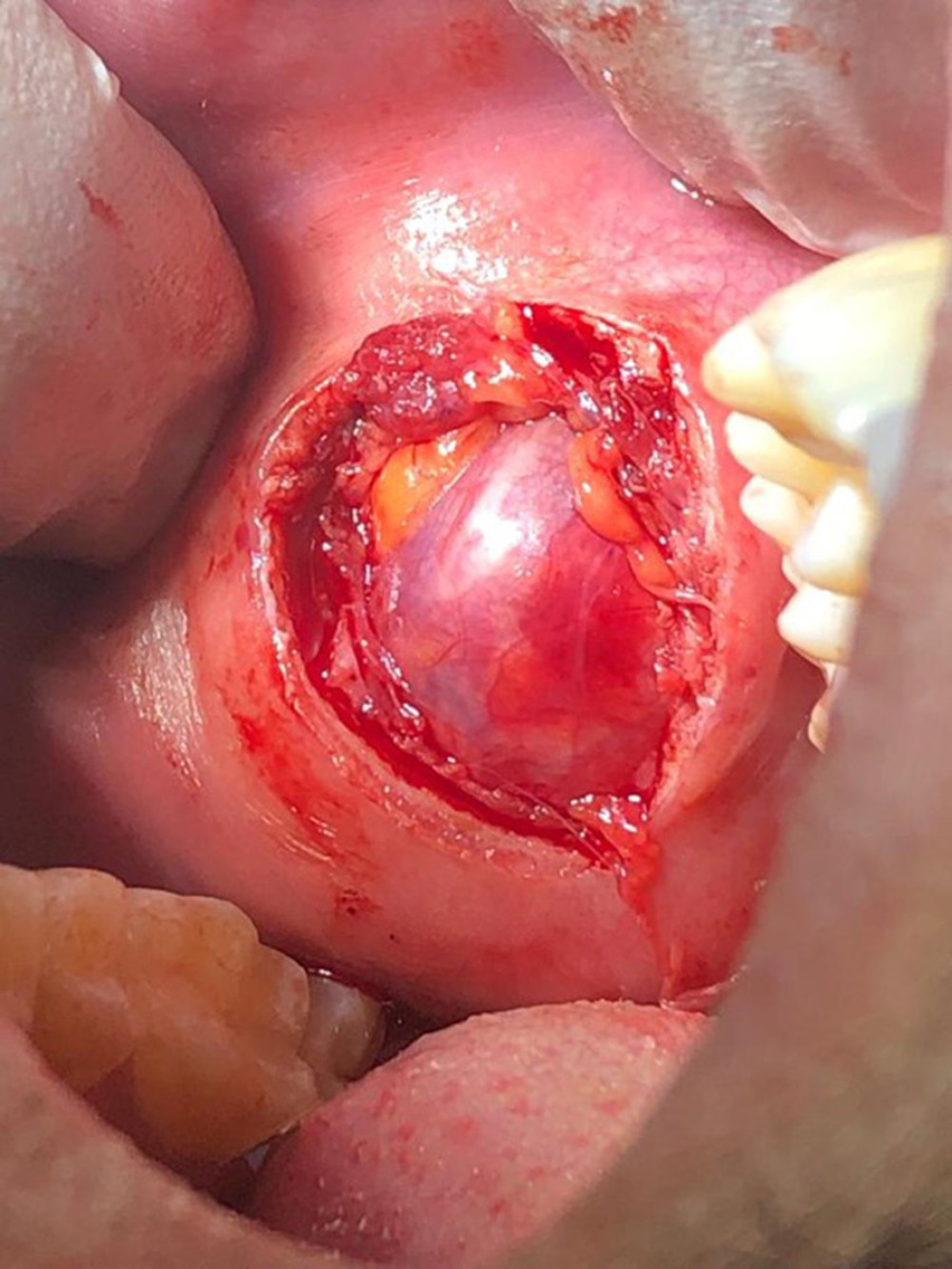 Intraoperative view of the lesion.
