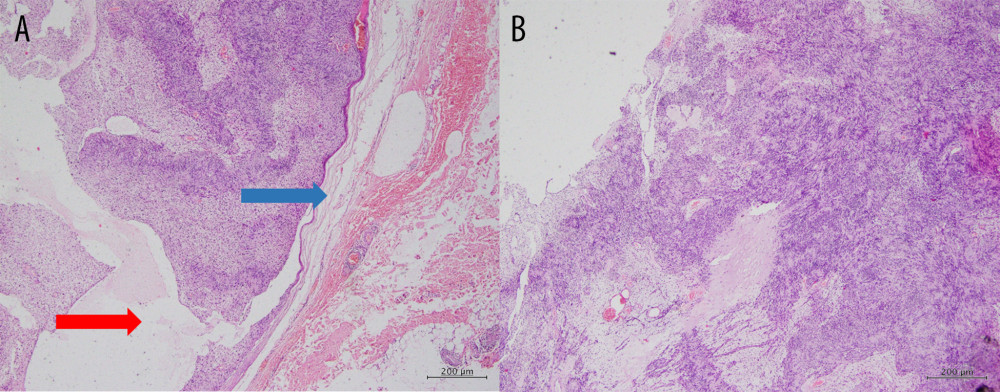 (A, B) Low-power magnification of H&E (4×) sections of ancient schwannoma showing a capsule around the lesion (blue arrow) and cystic spaces within the lesion (red arrow).