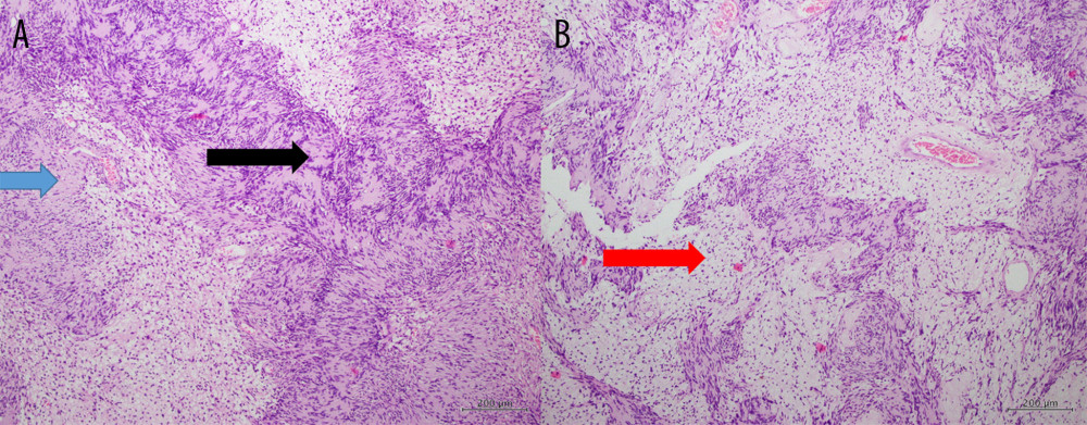 (A, B) Medium-power magnification of H&E (10×) sections show hyalinization (blue arrow) and myxomatous background (red arrow) with formation of blood vessels. Some areas show classic features of schwannoma, including Antoni A and Antoni B, as well as Verocay bodies (black arrow).