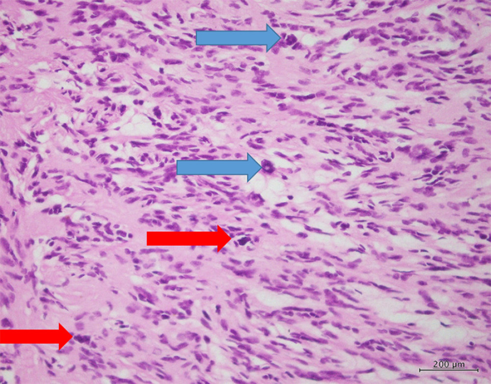 High-power magnification of H&E (20×) section shows pleomorphism (blue arrows) and hyperchromatism (red arrows) without mitosis.