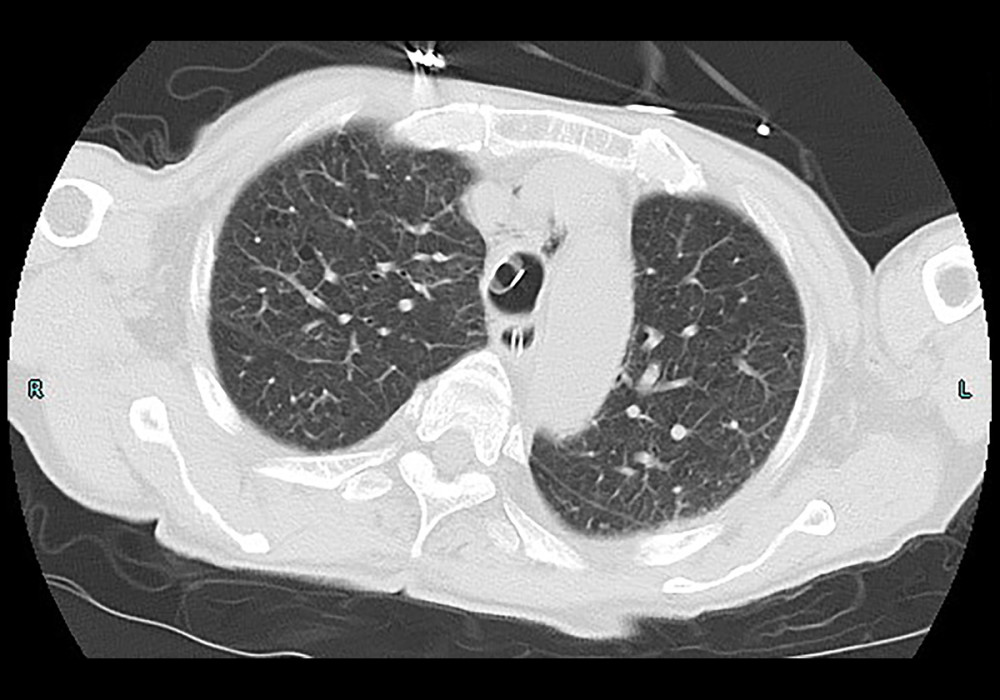 Transverse computed tomography images of the thorax at 24 h after surgery. The pneumomediastinum slightly improved, without air leaks.