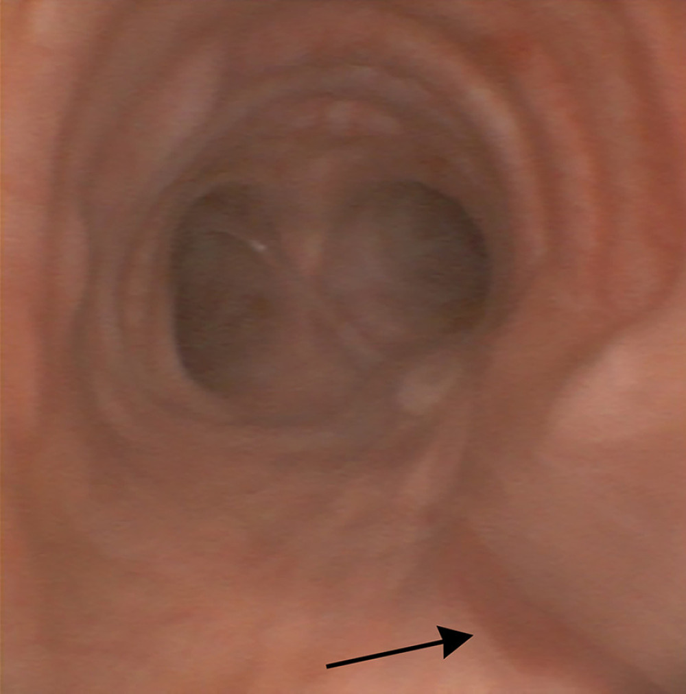 Bronchoscopy at 72 h after surgery. The tracheal injury showed healing (arrow).
