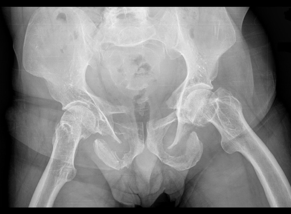 X-ray made on hospital admission, with a visible pelvic ring fracture (AO 61-B).