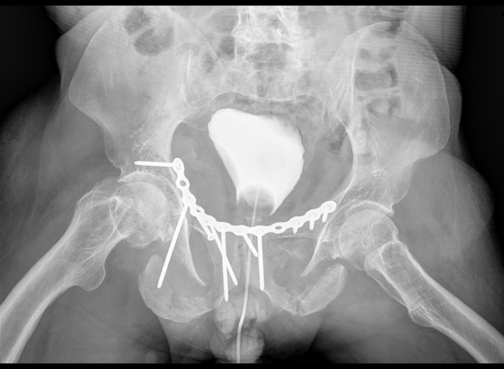 Postoperative X-ray. The fracture was fixated with a 12-hole reconstruction plate and cortical screws.