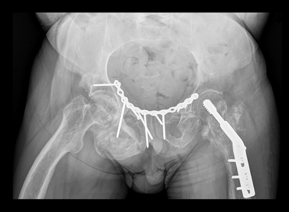X-ray made on the follow-up visit, 4 months after the first procedure. The dynamic hip screw and pelvic reconstruction plate are visible. There is radiographic bone union in the pelvis and femur and heterotopic ossification around the right obturator foremen. We have not been able to retrieve the preoperative X-ray, as part of the radiographic data was lost during a transfer between 2 servers.
