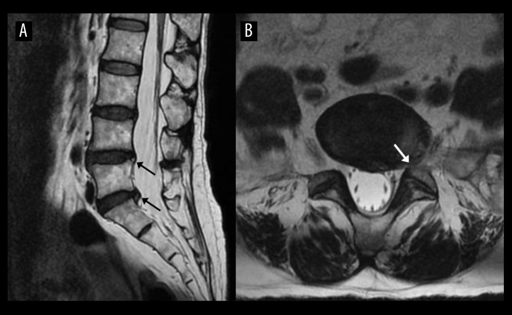 Lumbar spine magnetic resonance imaging 2 weeks prior to the patient’s chiropractic visit. The sagittal (A) T2-weighted image shows disc displacements with radial fissures at L4/5 and L5/S1 (arrows). The axial T2-weighted image (B) highlight a disc displacement at L5–S1 (arrow). The L5/S1 disc displacement was interpreted by a board-certified medical radiologist as a broad-based disc protrusion from the posterocentral to left foraminal region and was noted to contain an abnormal T2 hyperintense annular signal consistent with annular fissure.