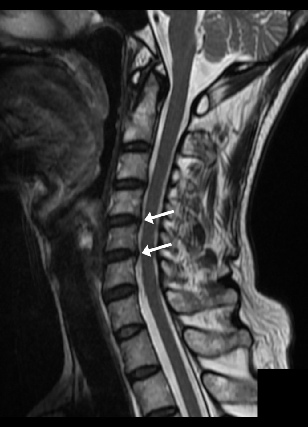 Cervical spine magnetic resonance imaging showing mild degenerative changes. This mid-sagittal T2-weighted sequence shows mild disc protrusions at C4/5 and C5/6 (arrows) causing mild cervical canal stenosis without cervical cord compression.