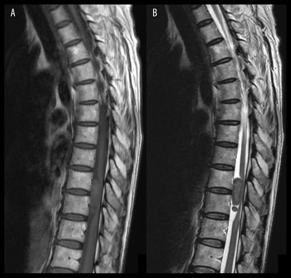 Thoracic spine magnetic resonance imaging showing an intraspinal mass. Sagittal T1-weighted (A) and T2-weighted (B) images show a mass extending from T9 to T10 with associated significant compression of the spinal cord. No extension to the neuroforamina or associated bony scalloping or bony erosion is seen.