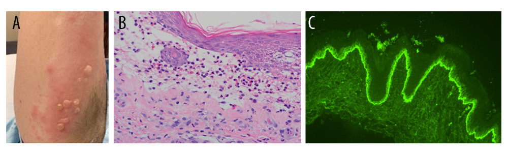 Representative skin lesions and histological findings of bullous pemphigoid on skin biopsy. (A) Multiple vesicular and tense bullae lesions over the upper arm presented on admission. (B) Hematoxylin and eosin staining of skin biopsy showed eosinophilic spongiosis, subepidermal cleft and mixed dermal inflammation with numerous eosinophils and neutrophils (magnification: 400×). (C) Direct immunofluorescence staining of skin biopsy revealed strong deposition of linear complement 3 along the basement membrane zones (magnification: 400×).