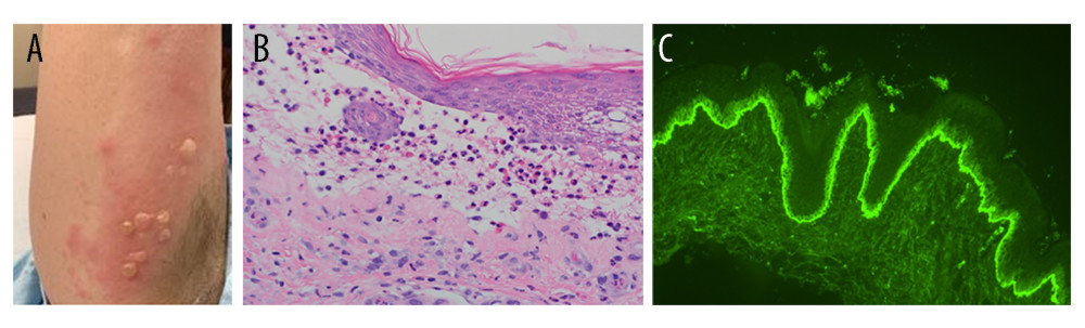 bullous impetigo histology