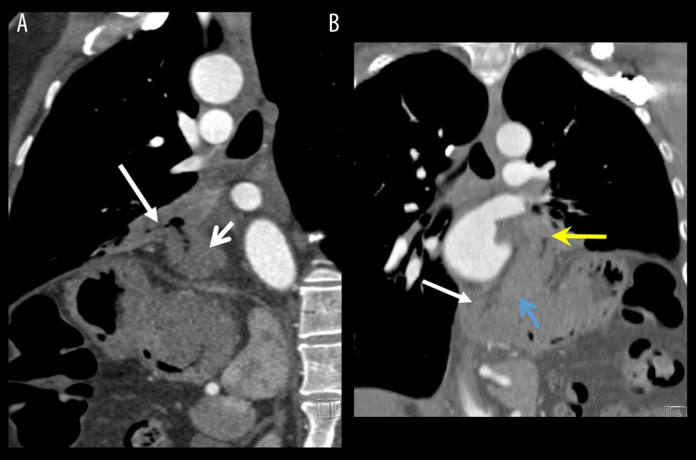 (A) Parasaggital view of computed tomography scan with fistula (white arrow left side) and herniated gastric fundus (white arrow right side). (B) Coronal view of computed tomography scan with esophagus (white arrow), diaphragm defect with hernia (blue arrow), and fistula (yellow arrow).