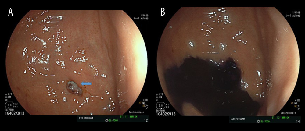 (A) Endoscopic view of the gastric fundus with the fistula orifice (arrow). (B) Endoscopic view after injection of toluidine blue solution.