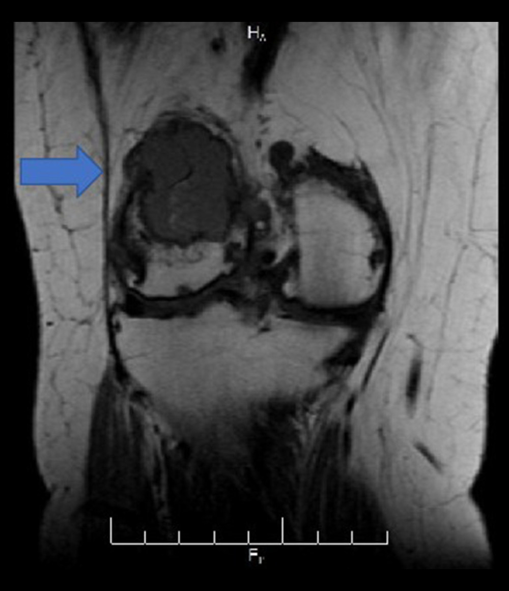 Knee magnetic resonance imaging coronal view T1 without contrast.