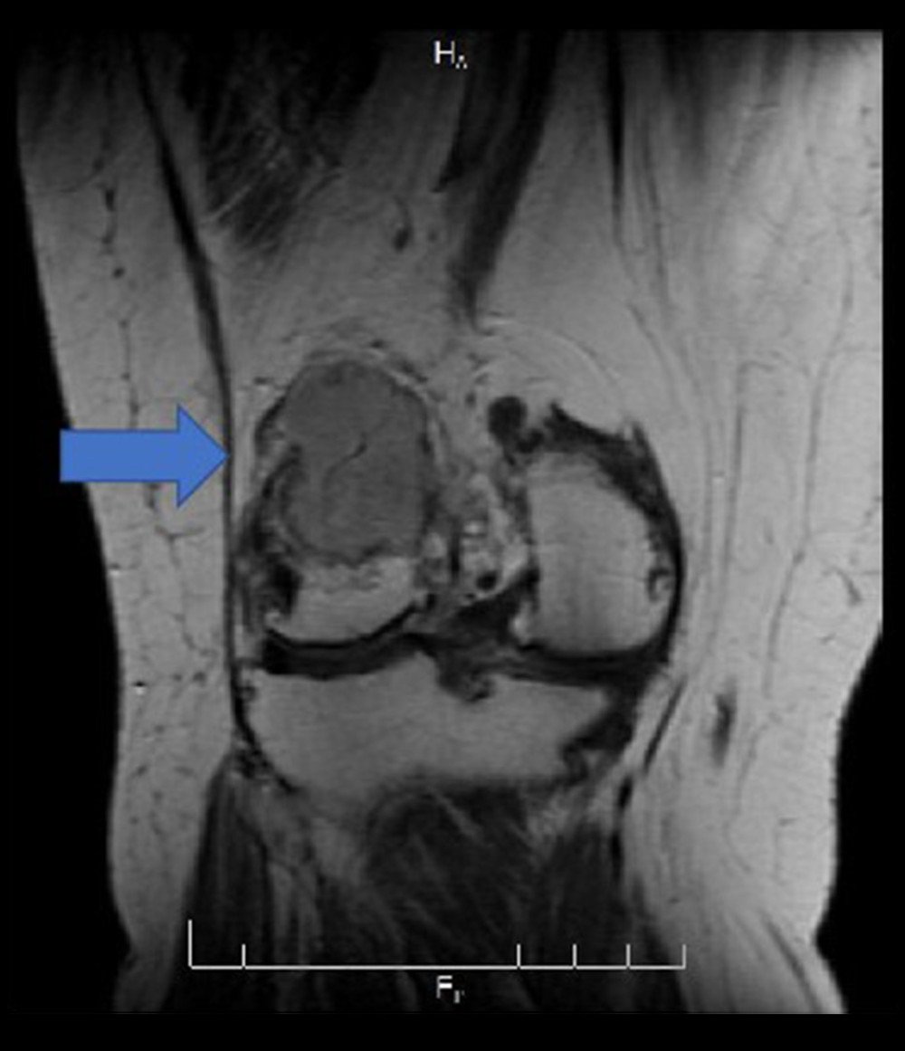 Knee magnetic resonance imaging coronal view T1 with contrast.
