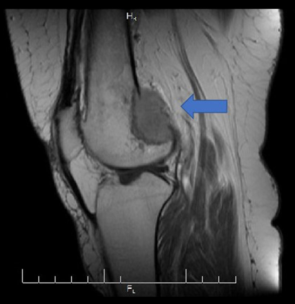 Knee magnetic resonance imaging sagittal view T1 with contrast.