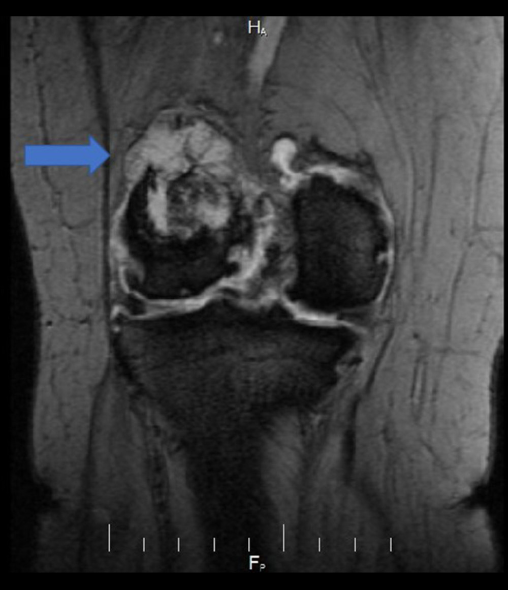 Knee magnetic resonance imaging coronal view gradient echo sequence showing a large enhancing distal femur mass, causing cortical destruction.