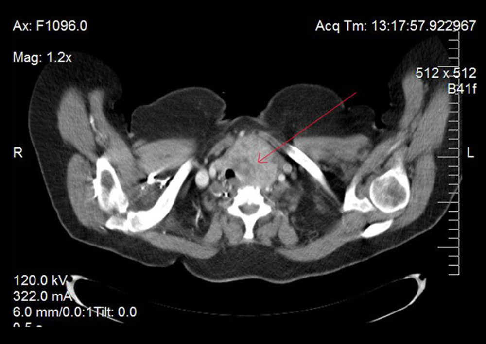 Axial sections of neck computed tomography with intravenous contrast showing a large heterogenous left thyroid mass with retrosternal extension, causing a mass effect and shifting of the midline structures.