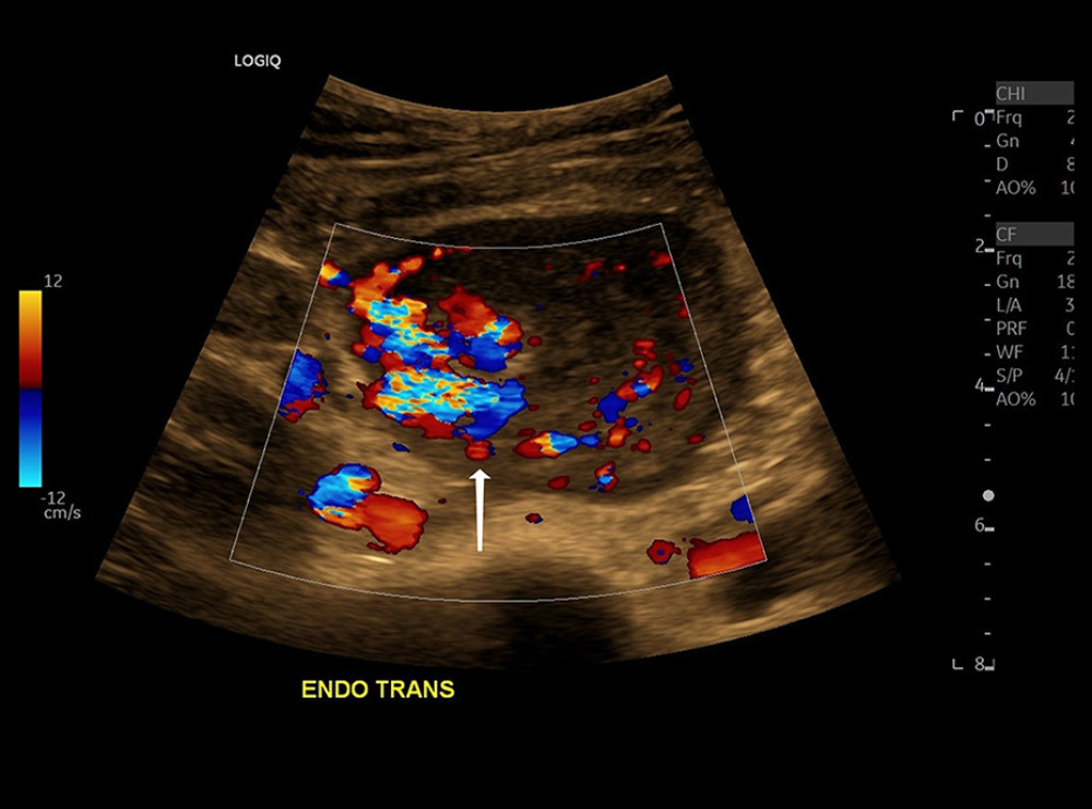 Color Doppler ultrasound demonstrating echogenic vascular structure posterior to the endometrial complex (white arrow).
