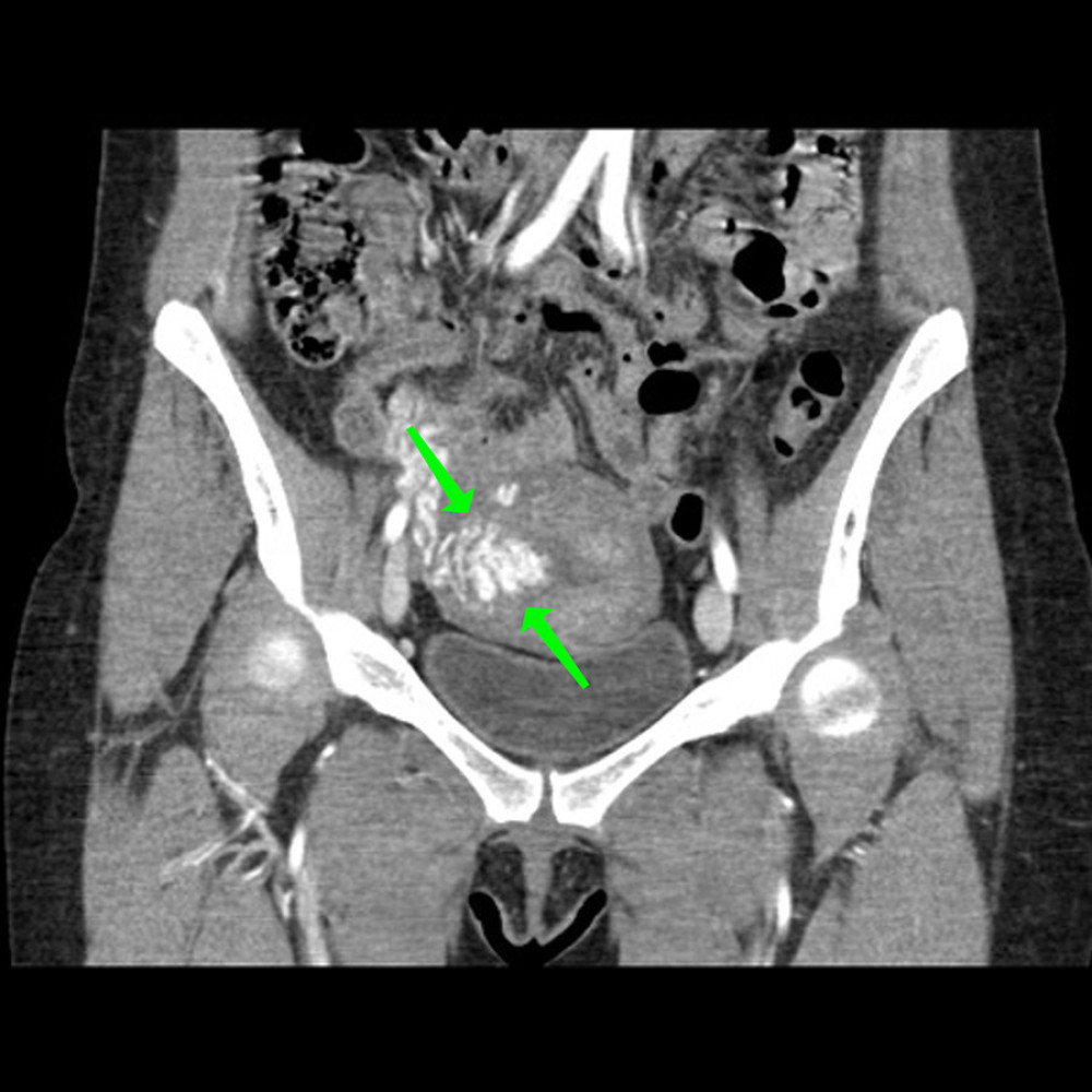 CT angiogram abdomen/pelvis coronal view demonstrating dilated parametrial and intramural serpentine vessels (green arrows).
