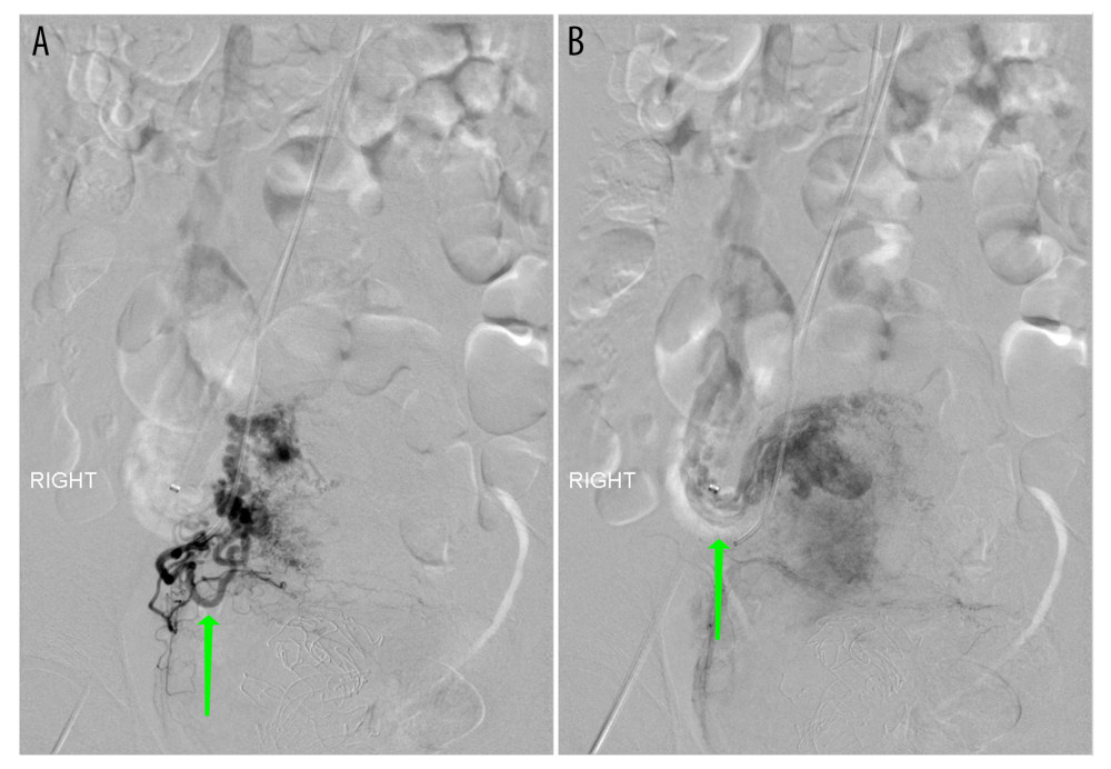 Right uterine angiogram arterial (A) and venous (B) phase demonstrating serpiginous dilated vessels with direct connection to a large draining vein compatible with uterine arteriovenous malformation (green arrows).