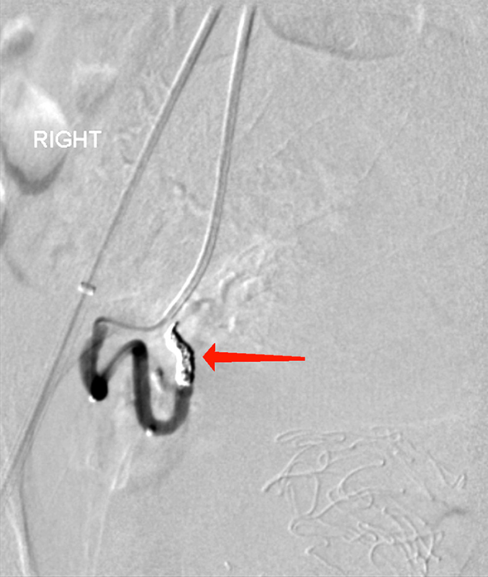 Postembolization arteriogram demonstrates coil packing of the right uterine artery with complete stasis of flow. No residual filling of AVM. Arrow demonstrates position of coils.