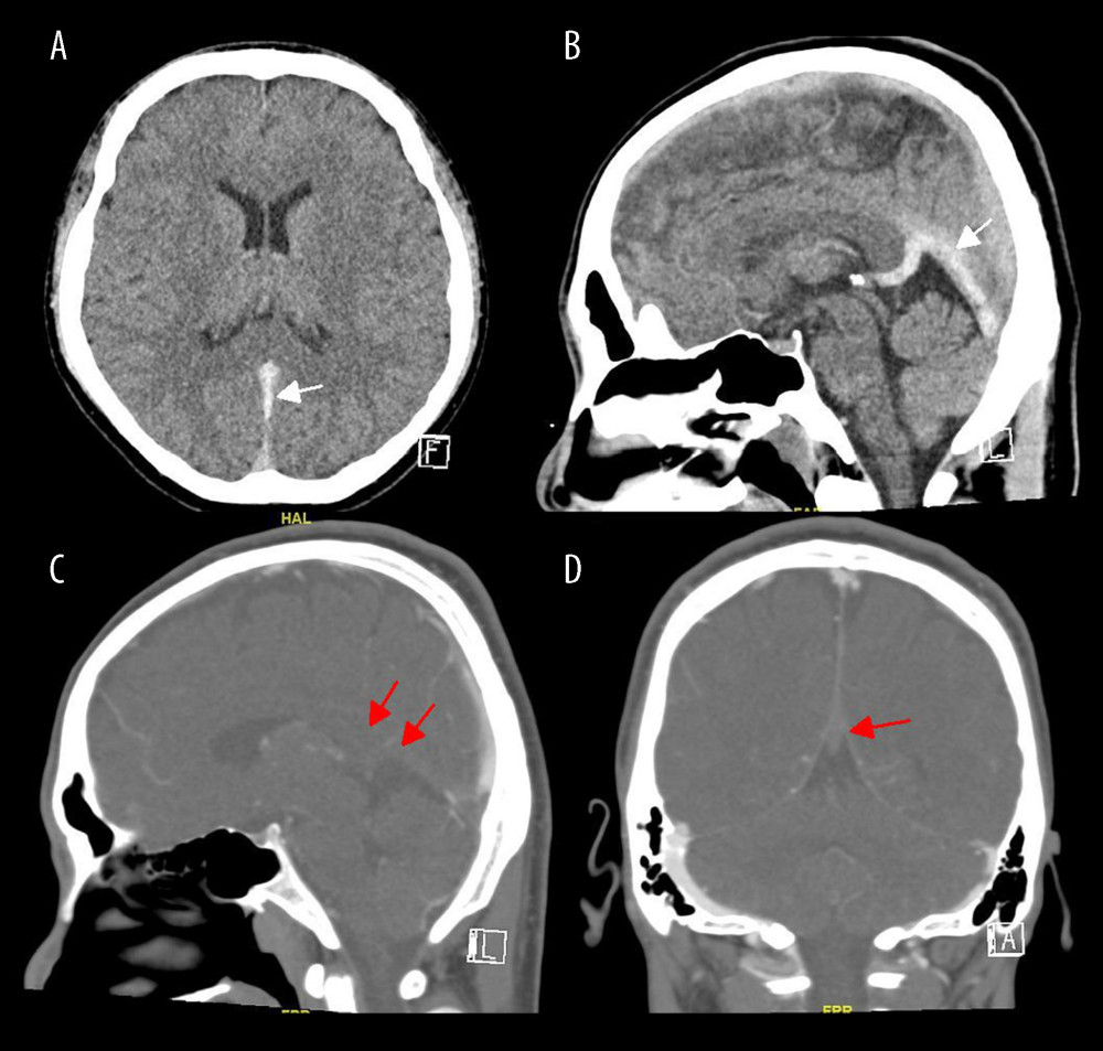 Axial (A) and sagittal (B) planes of the non-contrast-enhanced computed tomography (CT) brain show hyperdensity of the straight sinus, indicating venous sinus thrombosis (white arrows). Sagittal (C) and coronal (D) planes of CT venography show filling defects suggestive of thrombosis of the straight sinus and vein of Galen (red arrows).