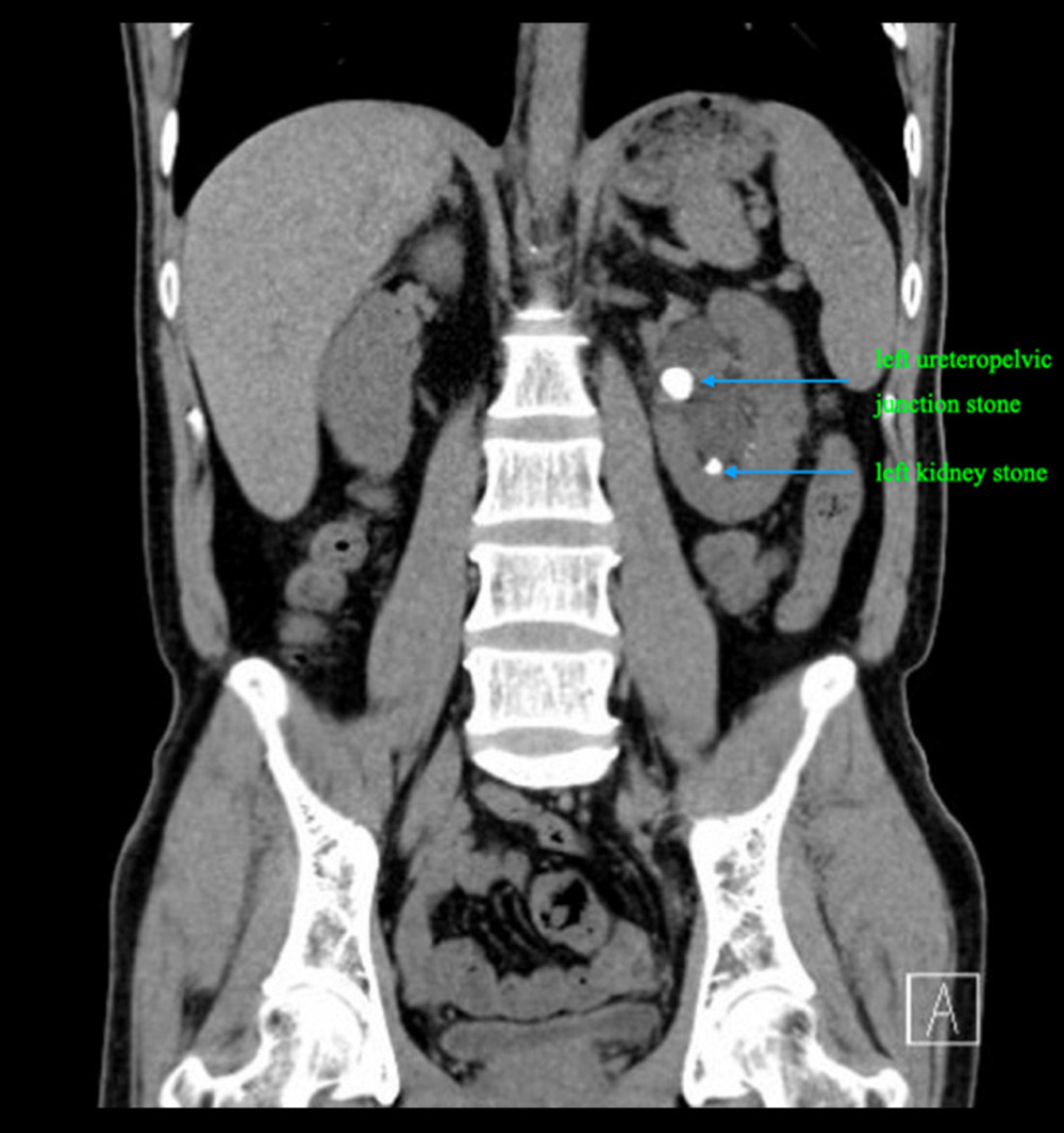 Urological CT of patient 1 suggested a left ureteropelvic junction stone and left kidney stone (as labeled).