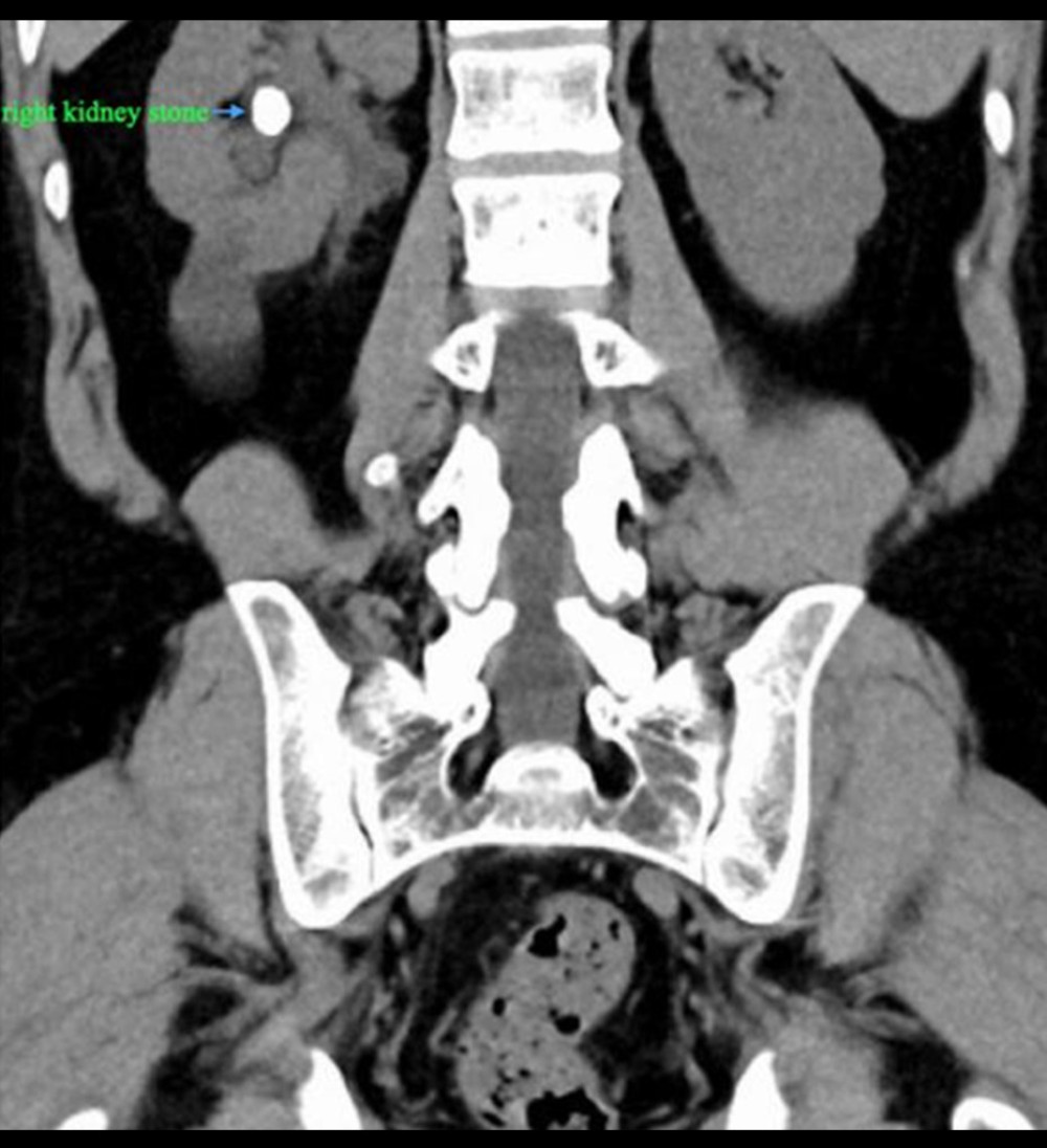 Urological CT of patient 2 suggested multiple renal stones in the right kidney (as labeled).
