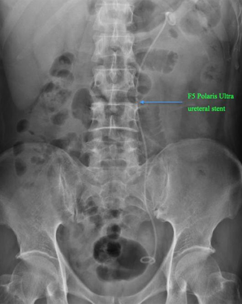 An X-ray of patient 1 showing that an f5 Polaris Ultra ureteral stent (as labeled) remained in place post-operation.