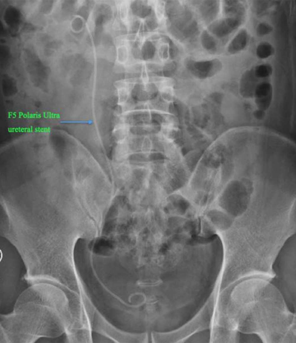 An X-ray of patient 2 showing that an f5 Polaris Ultra ureteral stent tube (as labeled) remained in place post-operation.