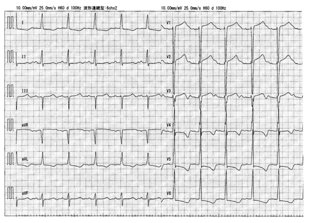 Electrocardiogram showed remarkable QTc interval prolongation (Bazett formula, 644 ms) and left ventricular hypertrophy (SV1+RV5 >35 mm, strain pattern on V5–6).