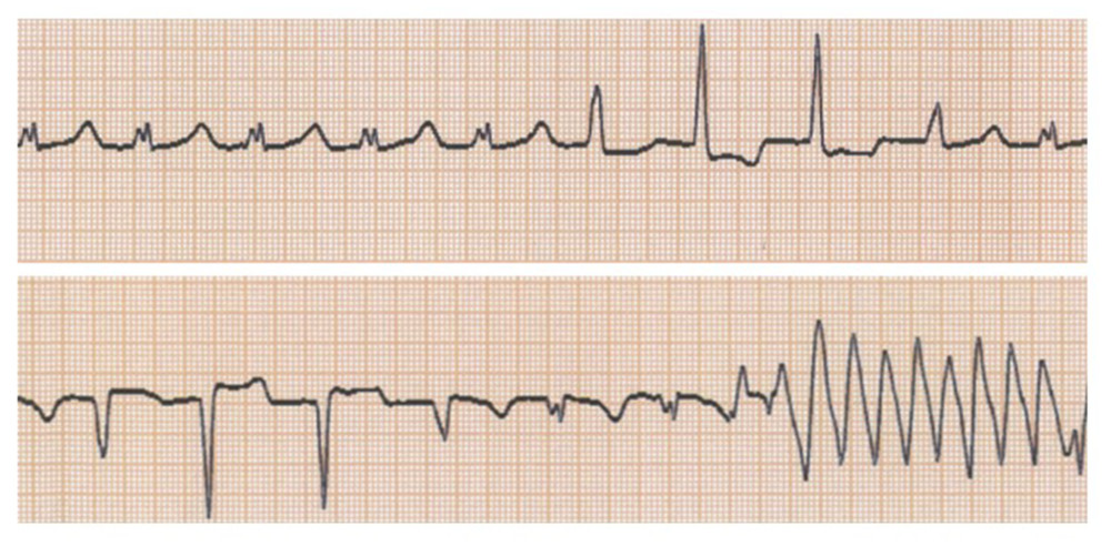 Electrocardiogram revealed a prolonged QTc interval of 643 m/s and ventricular fibrillation increased as R on T from the intrusion of premature ventricular contraction.