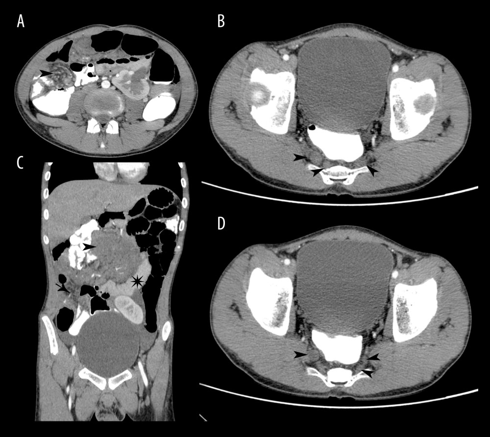 (A) Axial CT image at the level of the lower abdomen shows a swirling of the mesentery characteristic of volvulus alongside multiple soft-tissue density nodularities (arrowhead). (B) Coronal CT reconstruction demonstrates a large, confluent, nodular soft-tissue density mass involving a significant portion of mesentery (arrowhead) and encroaching upon the associated small bowel (star). Compare the appearance of the nodular mass with interspersed vessels to a portion of normal mesenteric fibroadipose tissue (arrow). (C, D) Axial images at the level of the pelvis shows nodular, thickened lumbosacral nerve roots (arrowheads).