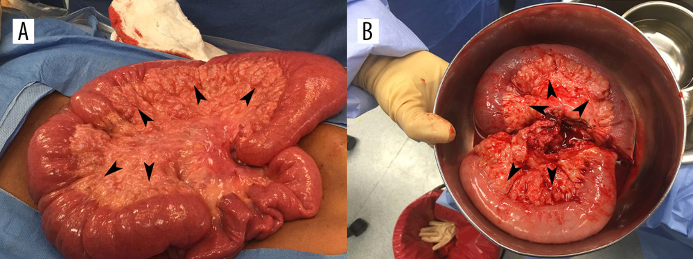 (A) Exploratory laparotomy performed showed a confluent, nodular mesenteric mass involving the mesentery, extending to the mesenteric root and to the associated bowel. Note the typical “bag of worms” (arrowheads) appearance characteristic of a plexiform neurofibroma. (B) During exploratory laparotomy, 36 cm of small bowel were resected with its associated mesentery infiltrated by the mass. Arrowheads highlight the extent of the mesenteric mass.