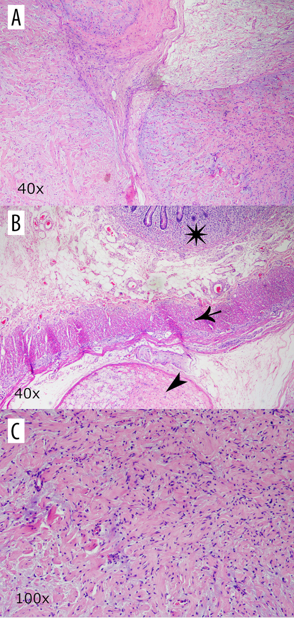 (A) Plexiform neurofibroma showing thickened tortuous nerve branches with increased amount of myxoid matrix growing in between fibroadipose tissue. 40× magnification. (B) Plexiform neurofibroma (arrowhead) pushing against the muscularis externa of the intestine (arrow). Normal intestinal mucosa seen at top (star). 40× magnification. (C) At higher magnification, the tumor presents as intersecting bundles of Schwann cells with pink cytoplasm and wavy, hyperchromatic nuclei present in a background of myxoid stroma. 100× magnification.