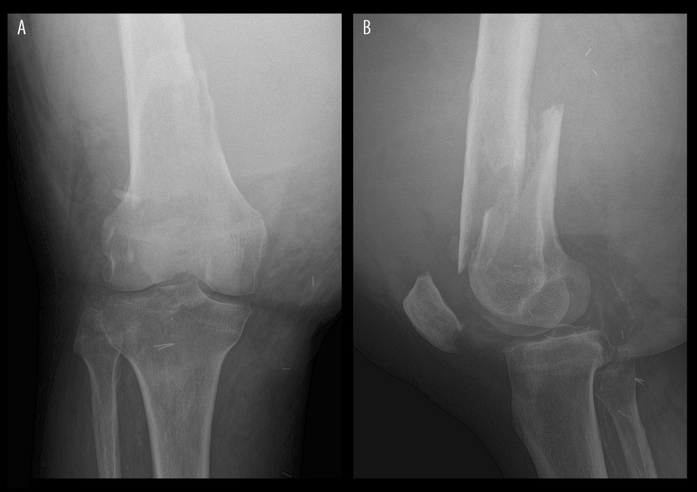 Preoperative X-ray of the distal femur: pathologic fracture (AO 33A2.2). Cortical bone scalloping is evident. (A) Antero posterior view; (B) Lateral view.