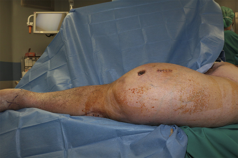 Preoperative clinical image. The giant soft-tissue mass (92 cm maximum circumference) is visible with the lower limb completely extra-rotated. Ulceration is visible on the antero-medial side of the thigh.