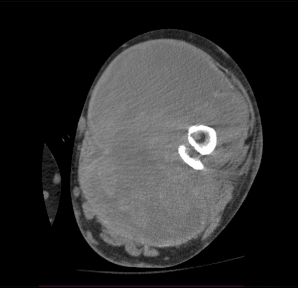 Axial computed tomography (CT) scan showing the soft-tissue mass almost circumferentially surrounding the fractured bone and extending into the anterior, posterior, and medial compartments.