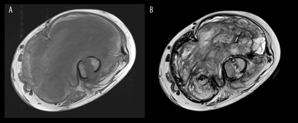 (A) T1-weighted magnetic resonance imaging (MRI) on axial plane showing the mass with an isointense aspect to the muscle, visible at the ipsilateral limb with a hyperintense ring. (B) T2-weighted MRI image on axial plane showing greater structural inhomogeneity.