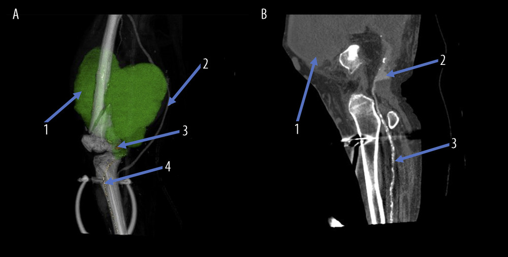 (A) 3D volume-rendering CT scan of the left tight, showing: (1) Giant pseudoaneurysm (green color). (2) Great saphenous vein bypass graft (GSV bypass). (3) Popliteal artery aneurysm (PAA). (4) Anterior tibial artery (ATA). (B) Sagittal CT scan view showing: (1) Giant pseudoaneurysm. (2) Popliteal artery aneurysm (PAA). (3) Anterior tibial artery (ATA).