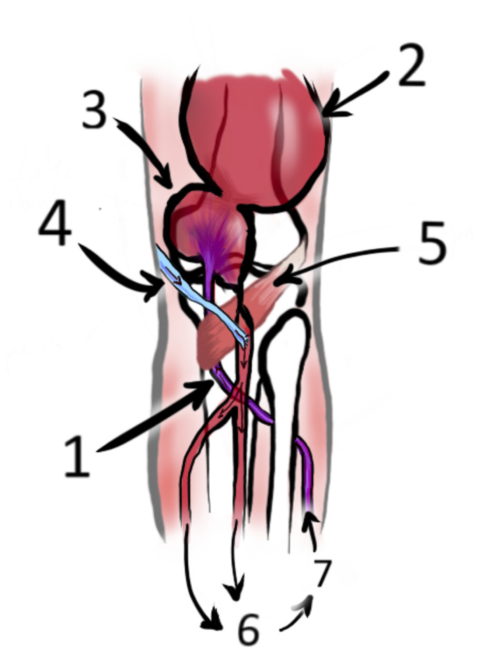 Descriptive and schematic drawing of the refueling mechanism of popliteal aneurism by ATA. (Drawn by Dr. Melani and used with permission). (1) Anterior tibial artery arising above the joint line, taking a medial path anterior to the popliteal muscle (Type 2A-2 of Kim Classification). (2) Pseudoaneurysm. (3) Legated popliteal aneurysm. (4) Femoro-popliteal bypass. (5) Popliteal muscle. (6) Foot/ankle circulation. (7) Retrograde blood flow reperfusion of the ligated aneurysm trough the anterior tibial artery.