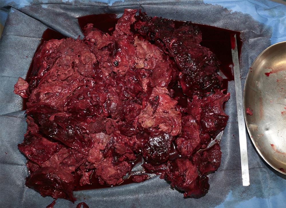 Intraoperative image, showing the organized hematoma removed from the pseudoaneurysm (3.6 kg) on a Mayo table.