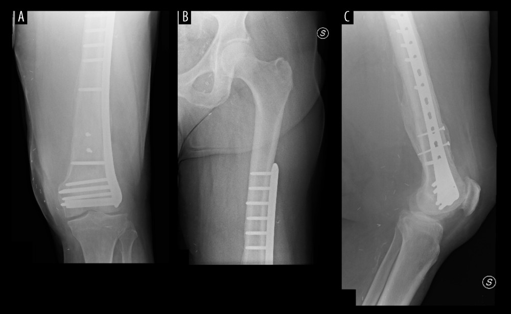 Radiographic control at 1 year, demonstrating complete fracture healing and remodeling. (A) Antero posterior (AP) distal view; (B) AP proximal view; (C) Lateral view.