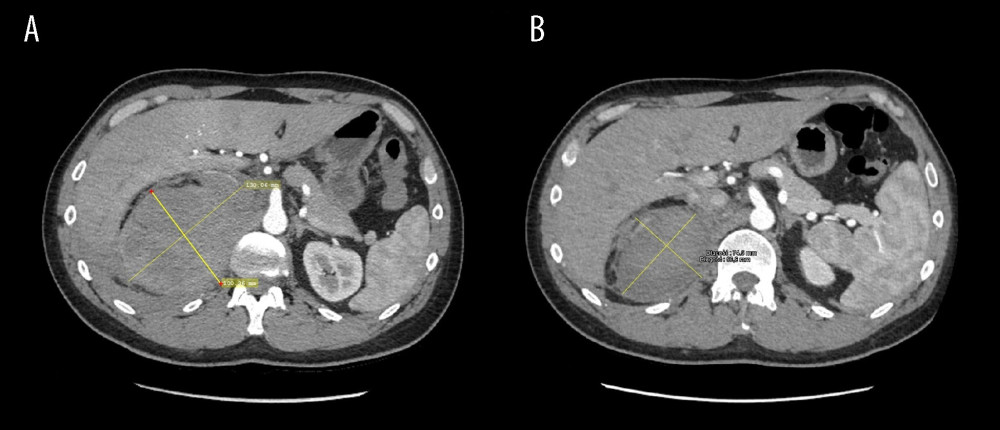 (A) Initial angio-CT scan of the abdominopelvic cavity shows the adrenal hematoma of 130×100 mm; (B) Angio-CT scan 3 weeks after the first examination shows decreased size of the hematoma to 90×60 mm.