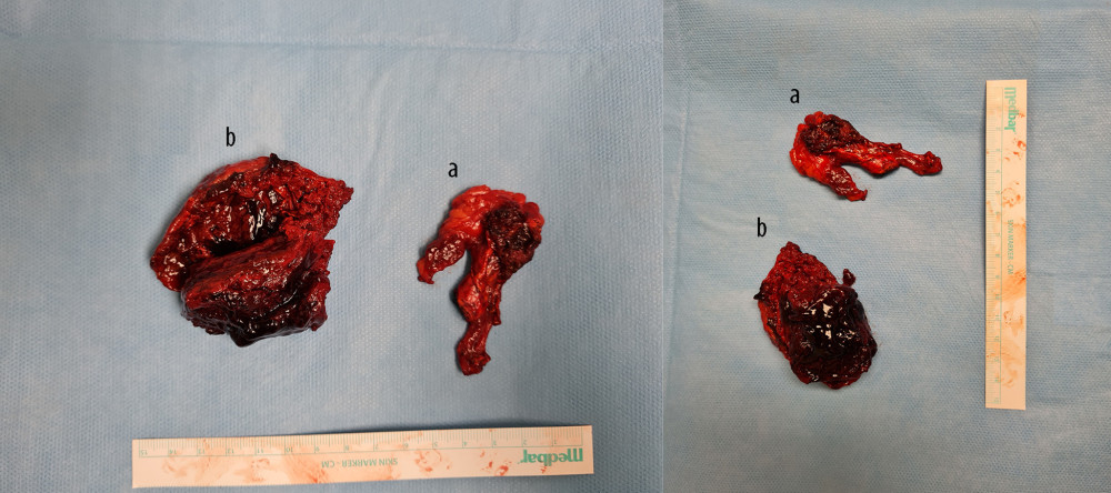 Adrenal gland with hematoma after surgical excision. a) Adrenal gland with hematoma; b) Hematoma.