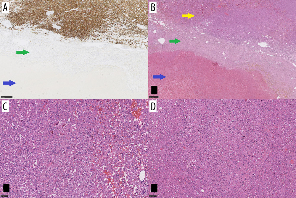 Postoperative histopathological examination. (A) (Hematoxylin and eosin staining) and (B) (immunohistochemical staining) were taken at low magnification and show hemorrhagic pseudocyst circuit in AAC, capsule, and hematoma content (yellow arrow indicates ACC, green arrow indicates the fibrous capsule, the blue arrow indicates blood and fibrine). (C, D) Show cells with compact, eosinophilic cytoplasm and nuclear pleomorphism (focally high nuclear grade).