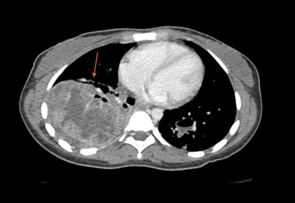 Demonstration of mass (red arrow) containing enhancing thick septation, debris, and fluid in the right medial lung, suggestive of progression of respiratory papillomatosis acute infection.