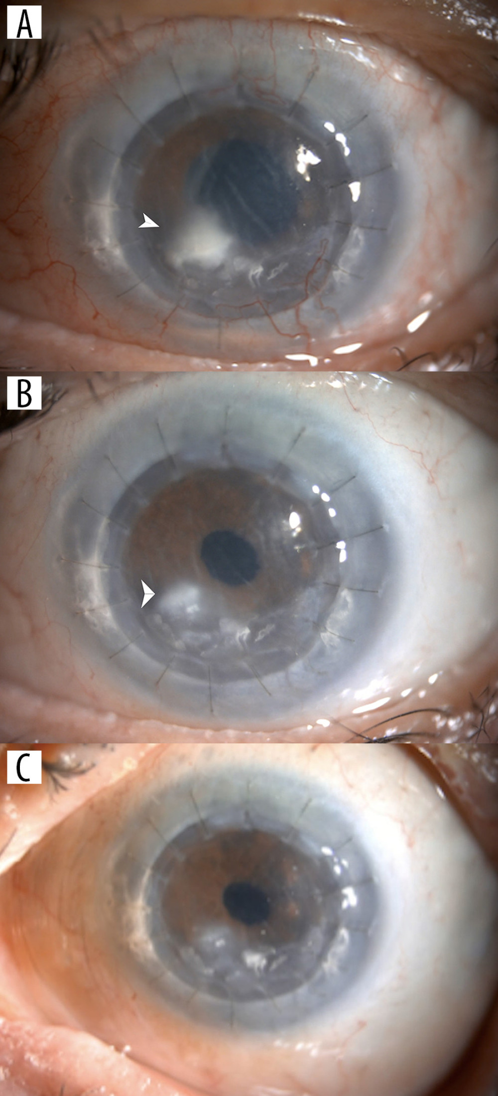 (A) Photo of the left eye showing the density of the corneal infiltrate with associated graft edema at presentation. (B) Photo of the left eye 2 weeks after treatment, with corneal scar, healed epithelial defect, and resolved hypopyon. (C) Photo of the left eye 2 months after treatment. The photo shows resolved graft edema with a faint superficial scar.
