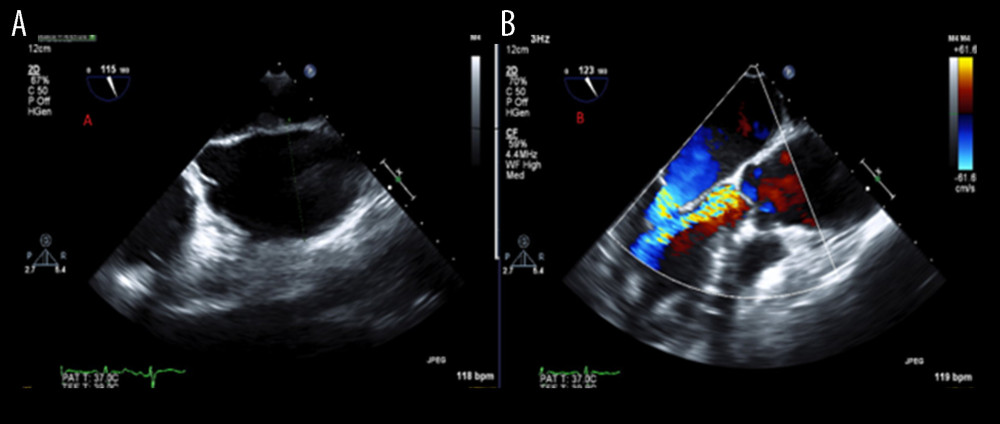 TEE mid-esophageal view: (A) Showing dilatation of ascending aorta measuring 4.6 cm. (B) Dilated ascending aorta with severe aortic insufficiency.